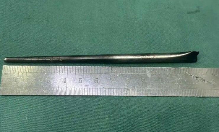 12 cm metal chopstick in man's throat for 8 years