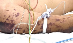 Common questions about meningococcal disease