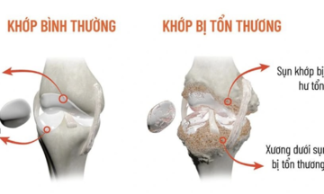 Why do joints crackle?