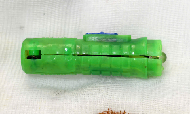 Rusted foreign object in girl's body for 5 months