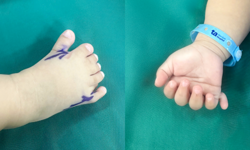 Girl has 26 fingers and toes