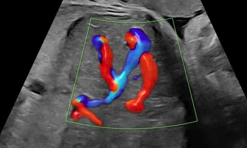 Rare fetal hepatic vascular malformation detected