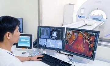 Stent placement for 90% blocked coronary artery
