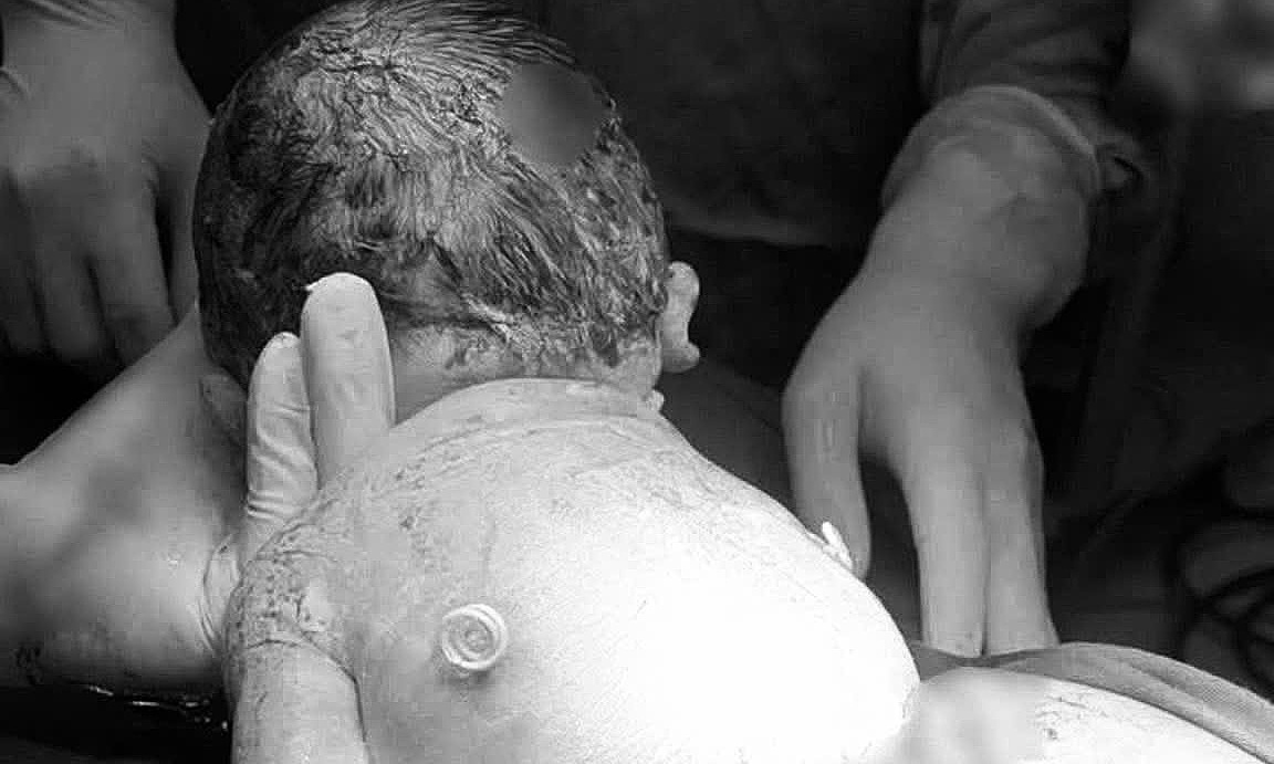 Baby born with 'small wings' on back after life-saving fetal intervention