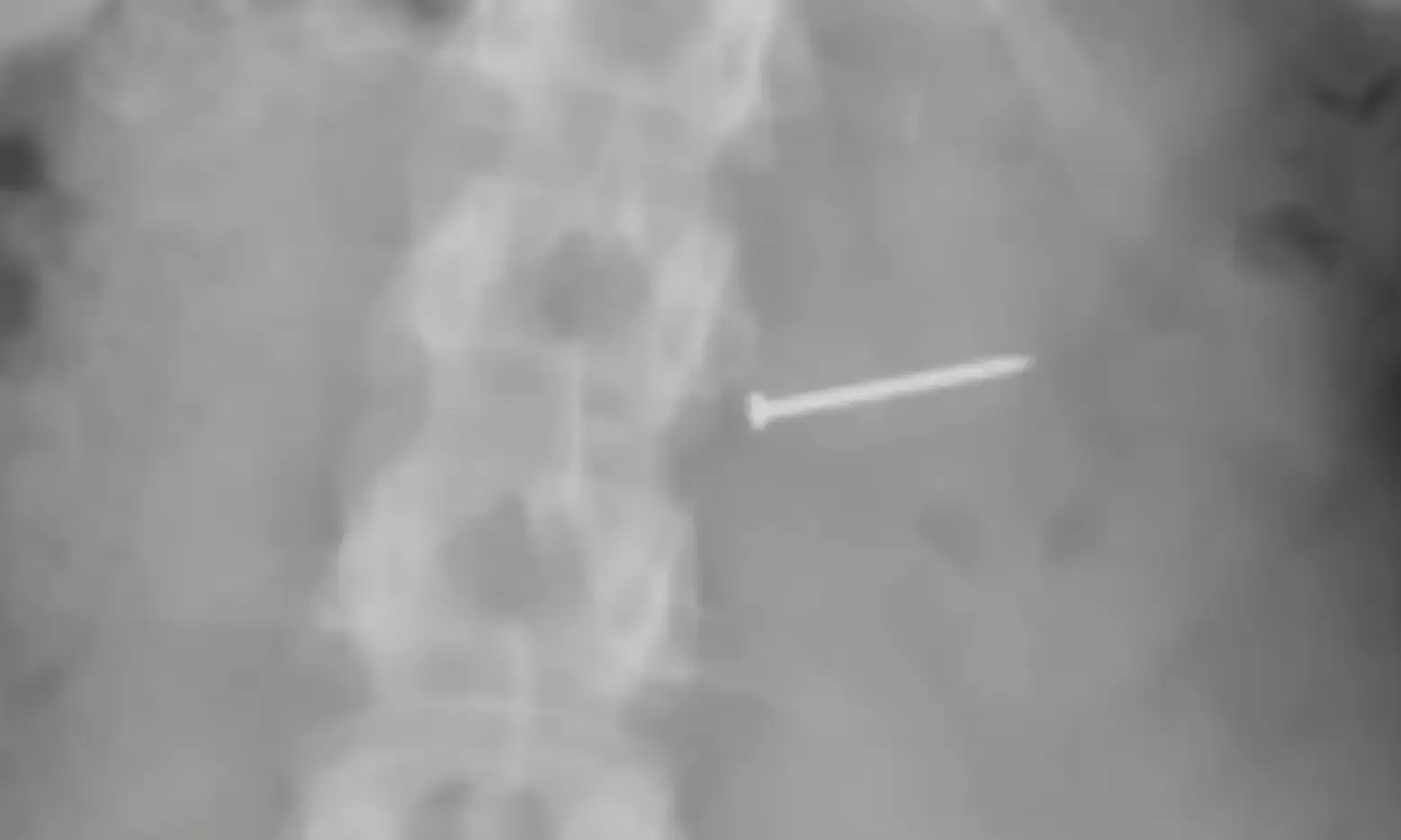 Florida woman awarded $14 million after finding nail in ice cream