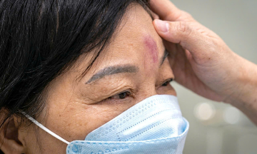 Incorrect filler injections can cause permanent blindness in minutes