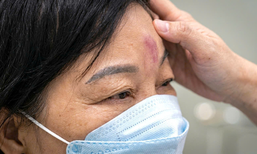 Incorrect filler injections can cause permanent blindness in minutes