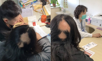 Mother experiences significant hair loss from late-night study sessions with son