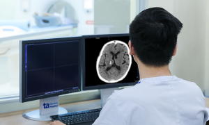 Cerebral hemorrhage due to hypertension