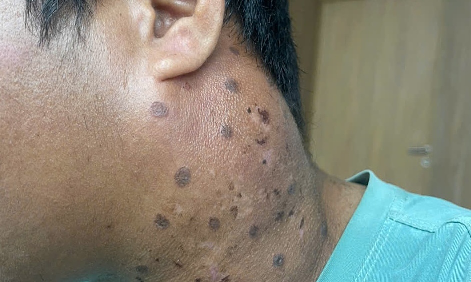 Man mistakes common cold symptoms for late-stage cancer