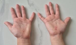 Mistakes costing the 'golden hour' to save children with hand, foot, and mouth disease