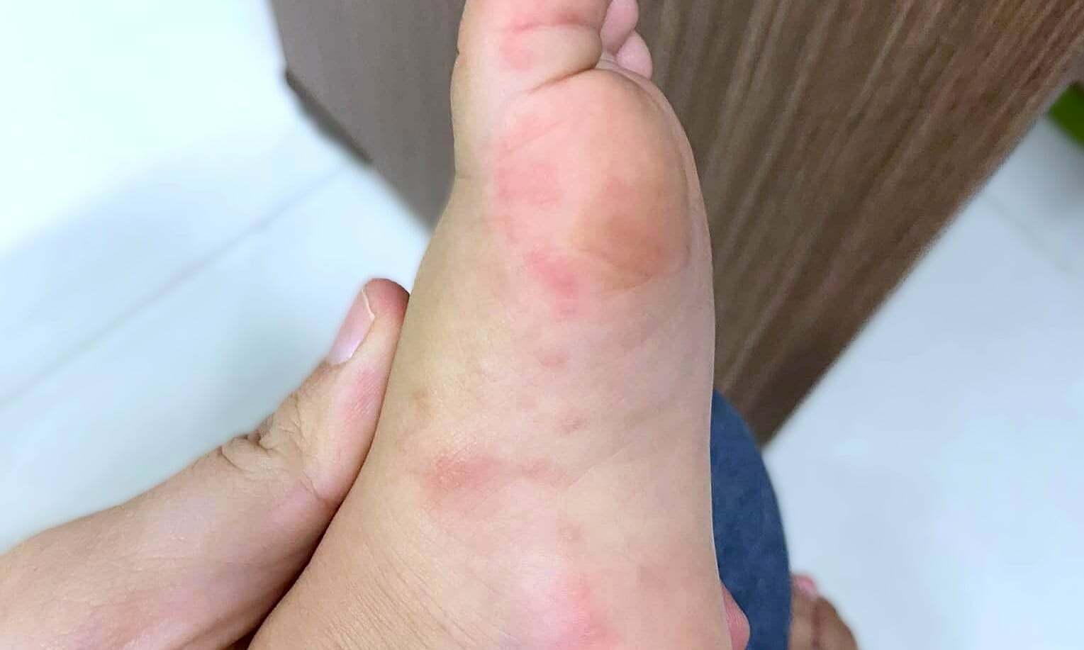 Should topical medication be applied to ulcers in children with hand, foot, and mouth disease?