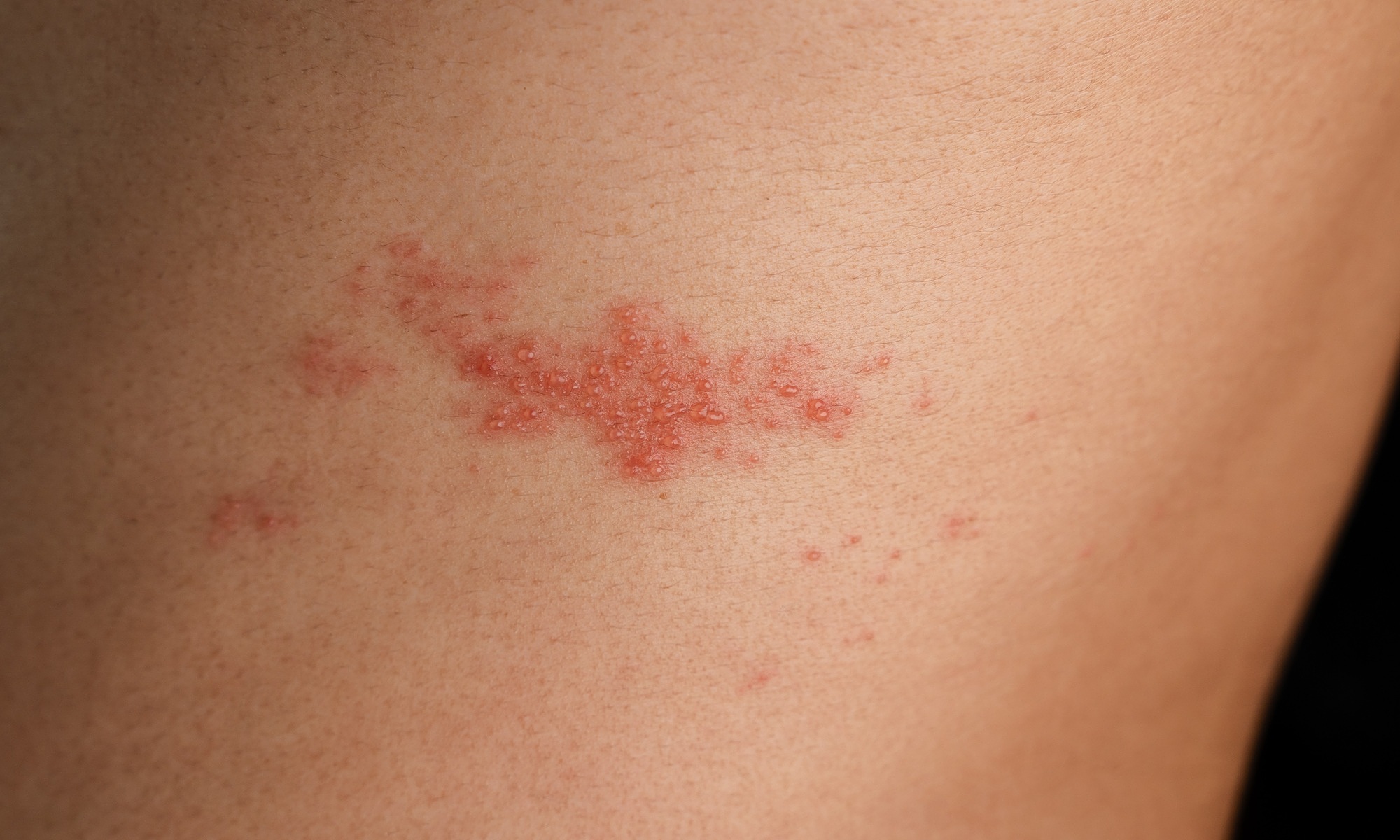 Prolonged pain from severe shingles