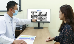 What are tonsil stones?