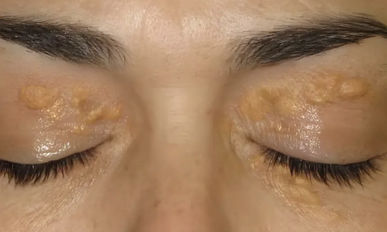 two facial signs warn of dangerously high bad cholesterol levels