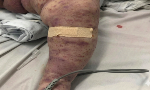 4 deaths from meningococcal disease, Ministry of Health warns of epidemic