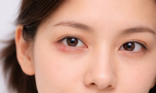 Why do eyelid bumps appear?