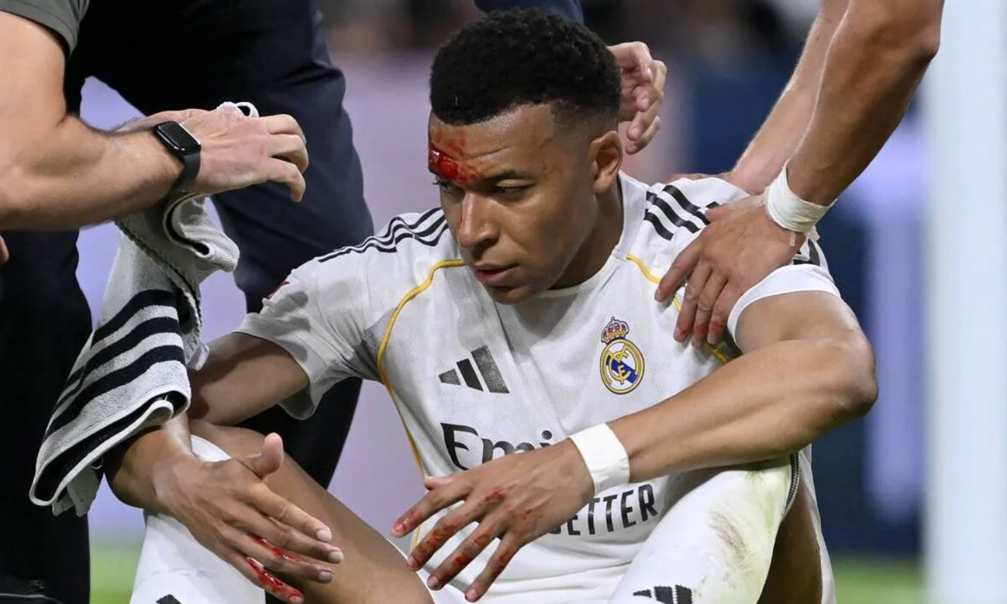 Mbappe receives three stitches on forehead after collision