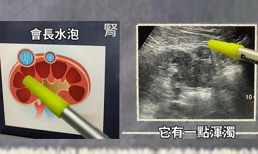Blurry spot on abdominal ultrasound reveals malignant kidney tumor