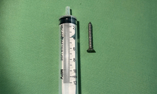 Girl swallows 2.5 cm screw