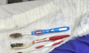 Three toothbrushes nearly 20 cm long removed from young man's stomach