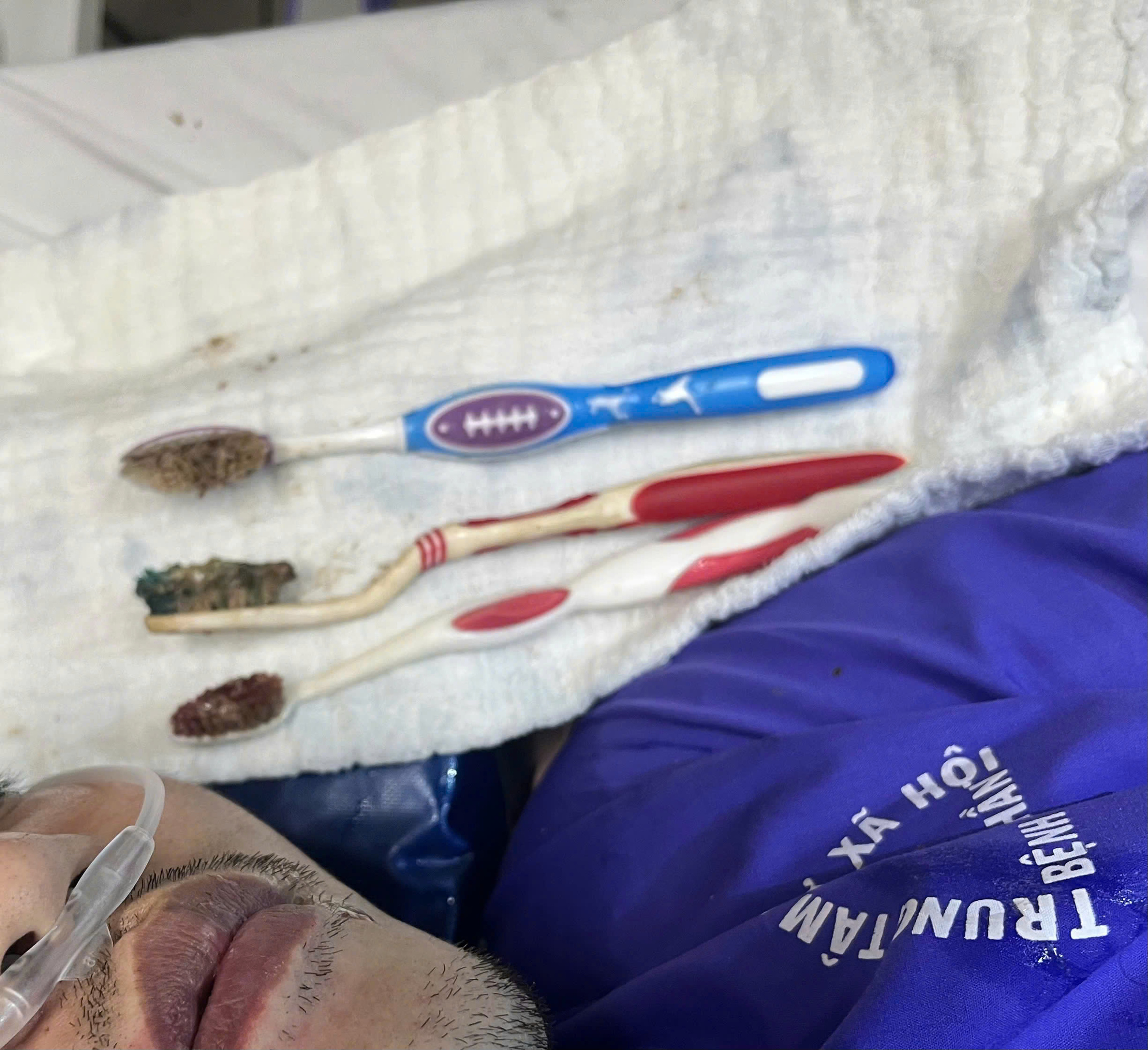 Three toothbrushes nearly 20 cm long removed from young man's stomach