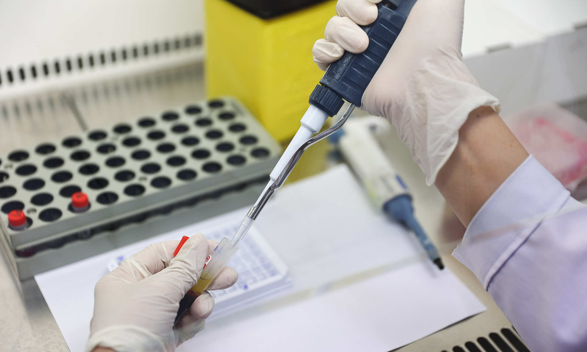 Girl suddenly seizes, doctors discover glomerulonephritis after sore throat