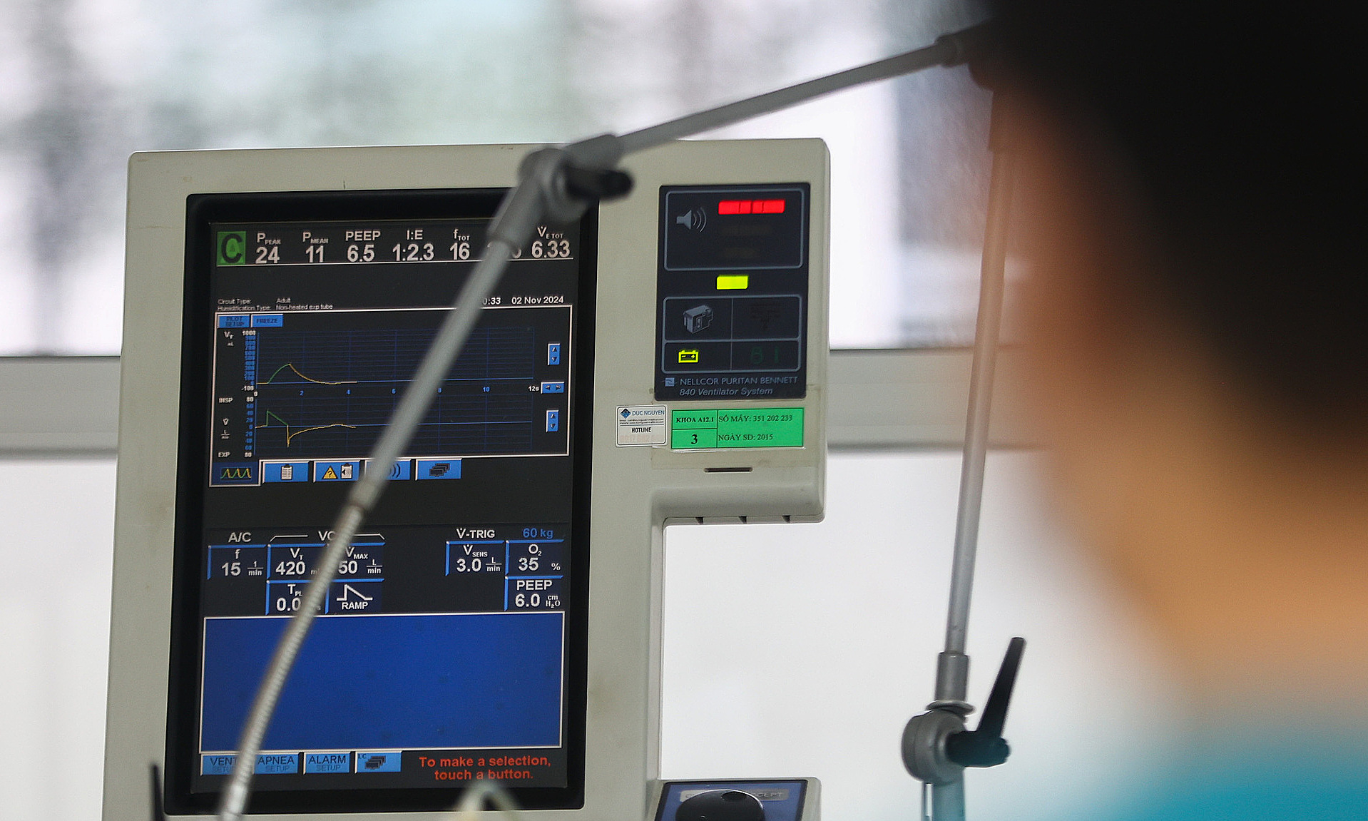 Septic shock, multiple organ failure after processing pork