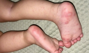 Girl with hand, foot, and mouth disease complicated by bronchitis