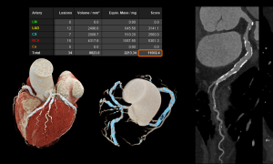 Photon-counting CT technology aids early lesion detection