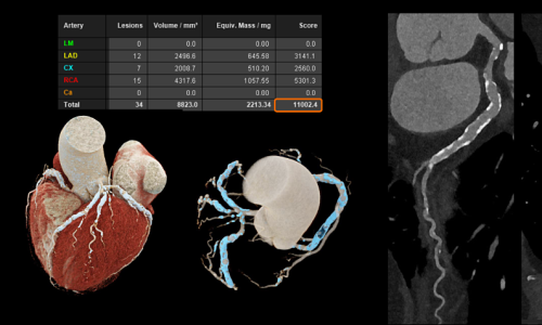 Photon-counting CT technology aids early lesion detection