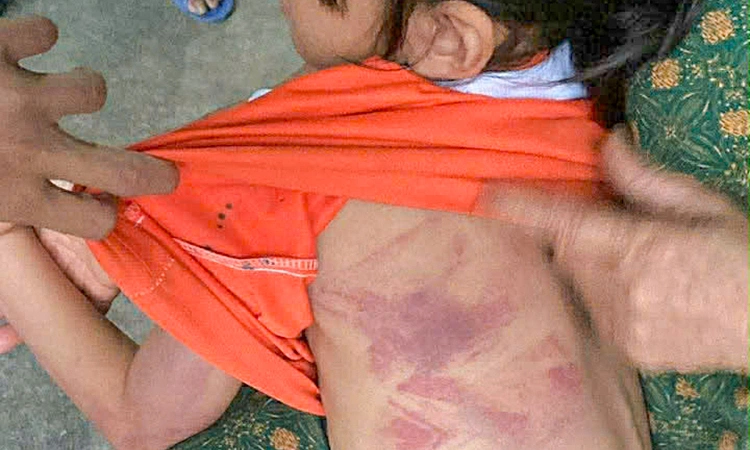 Second-grade girl severely bruised after classmate's assault