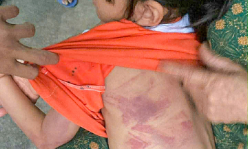 Second-grade girl severely bruised after classmate's assault