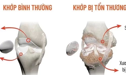 Why do joints ache and stiffen more in hot weather?