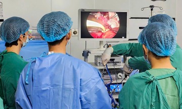 Laparoscopic resection of liver segment with tumor for cancer treatment
