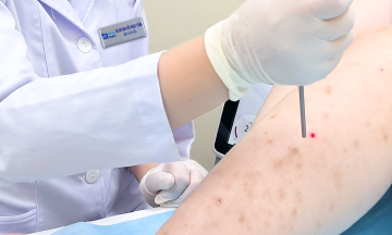 Dermatitis after hair removal