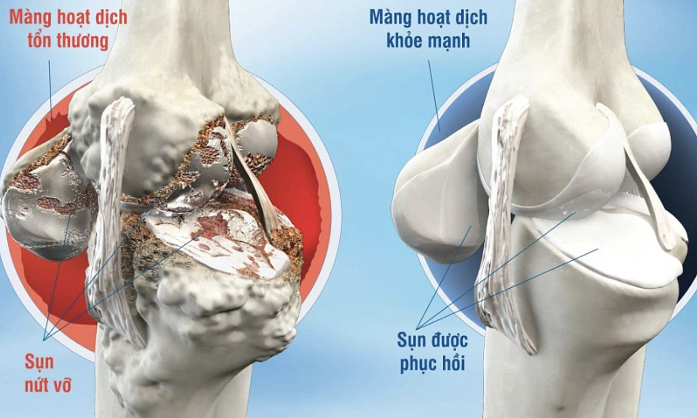 5 joints in the body prone to degeneration