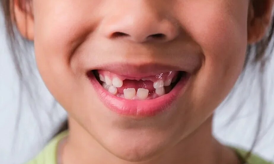 'Golden 30 Minutes' to Save a Child's Knocked-Out Permanent Tooth