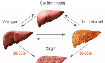 Why fatty liver disease can progress to liver cancer
