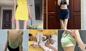 23-year-old woman emaciated, loses menstruation due to weight loss injections