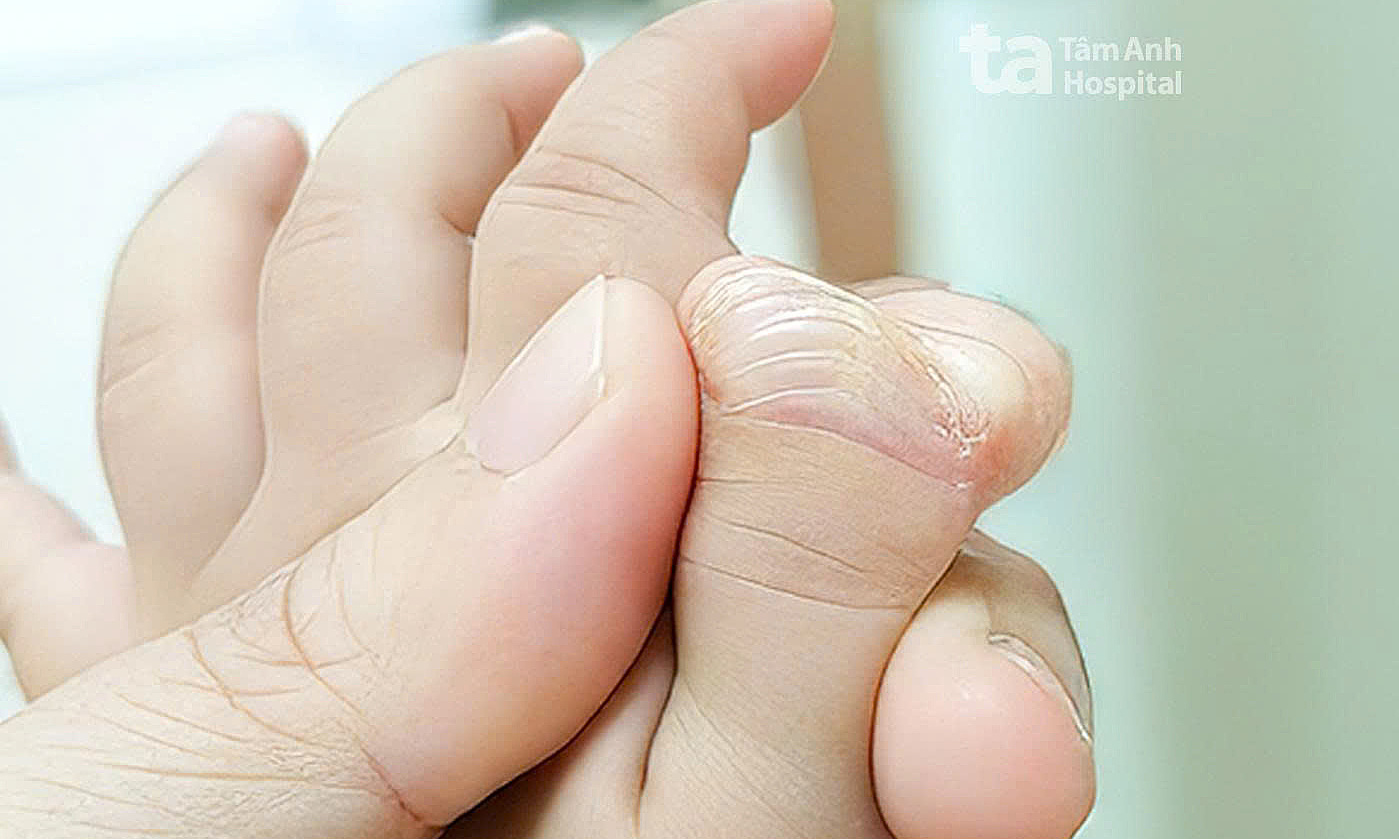 Girl born with two thumbs on one hand