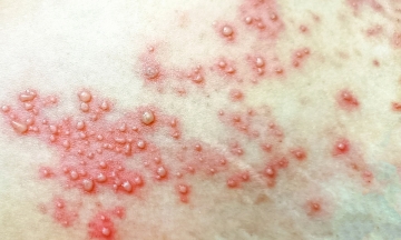 Agony from shingles near the anus
