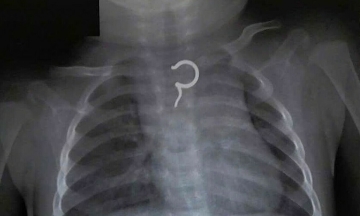 Earring removed from 8-month-old girl's esophagus