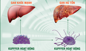 6 common causes of elevated liver enzymes