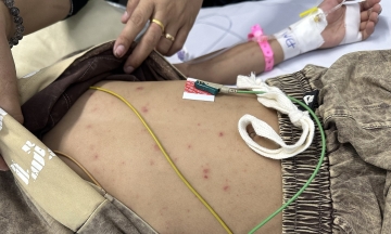One in six meningococcal disease cases is fatal