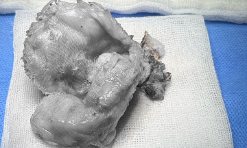 Shoulder and neck pain due to foreign object after breast augmentation