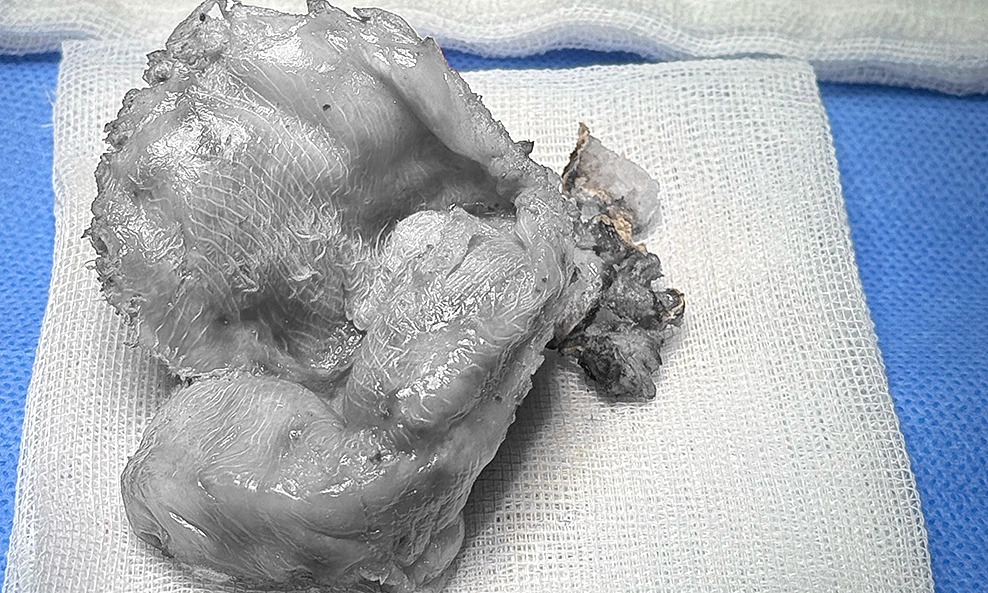 Shoulder and neck pain due to foreign object after breast augmentation