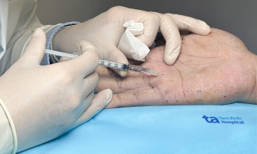 Botox injection reduces hand sweat by 70% in one session