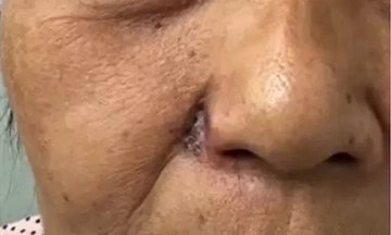 Mole turns cancerous, destroying woman's nose