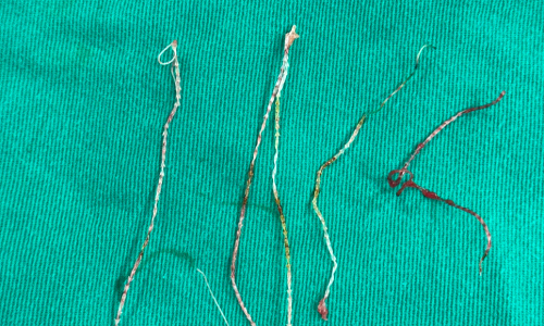 Doctor removes infected threads from woman's face after cosmetic procedure
